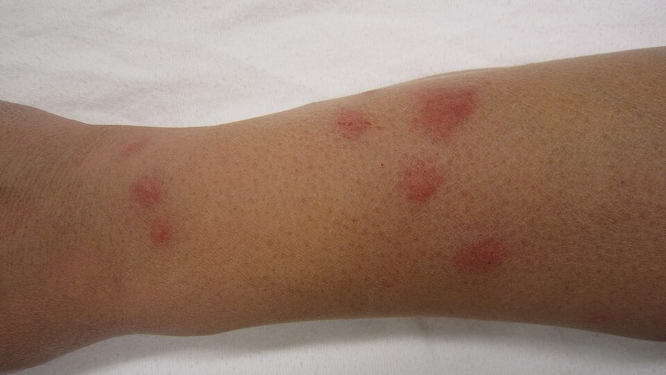 Intepaturi plosnite